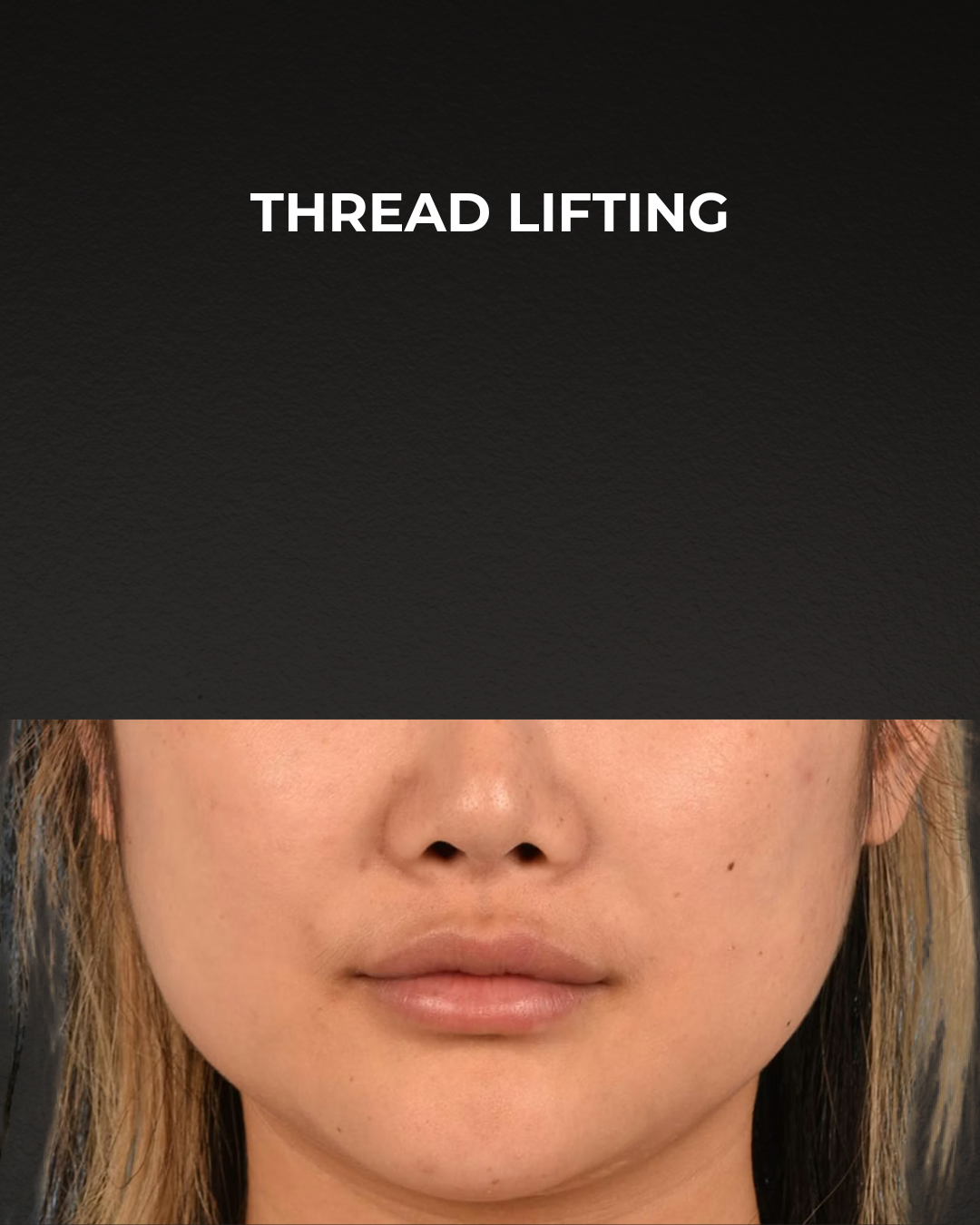 Thread Lifting Before & After Gallery - Patient 132694 - Image 1