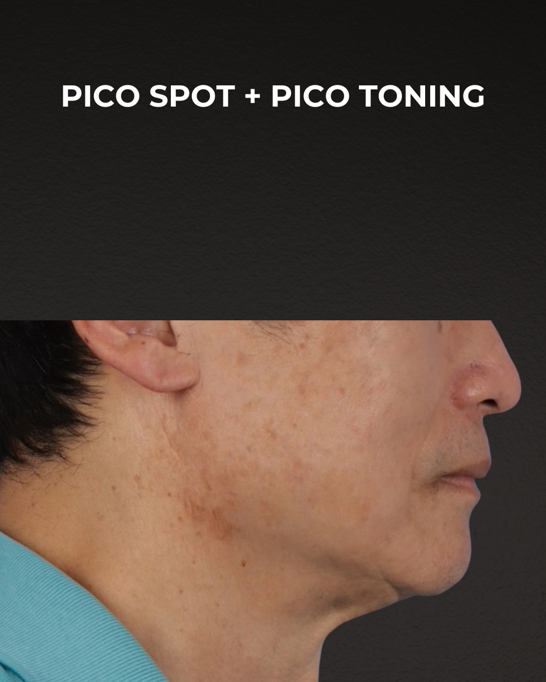 Pigment Laser Before & After Gallery - Patient 297186 - Image 4