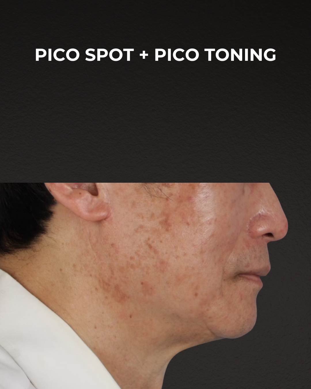 Pigment Laser Before & After Gallery - Patient 297186 - Image 3