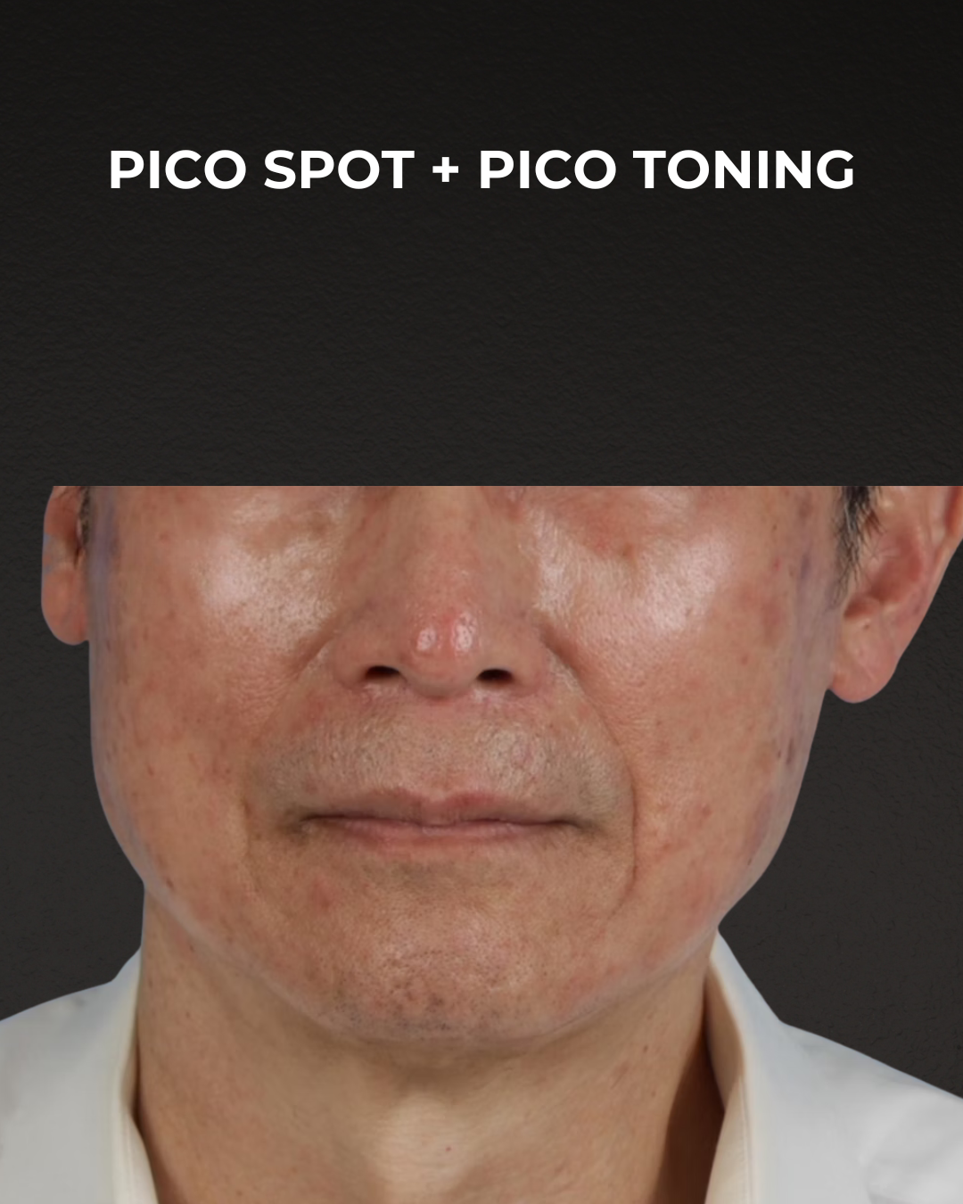 Pigment Laser Before & After Gallery - Patient 297186 - Image 1