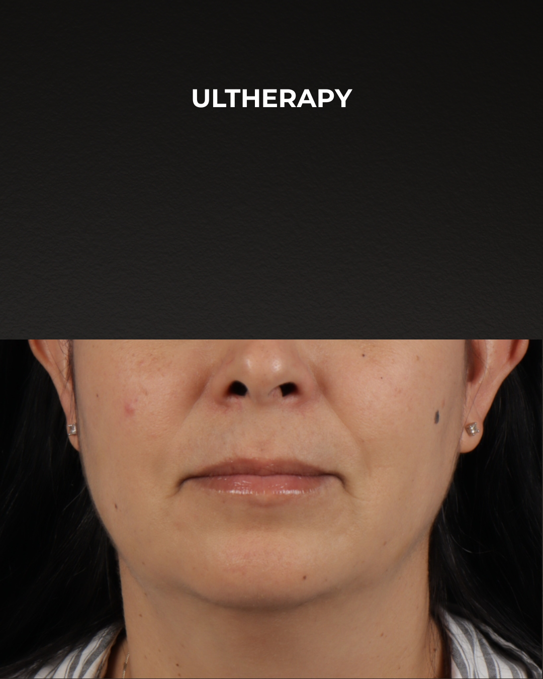Ultherapy Before & After Gallery - Patient 385000 - Image 2