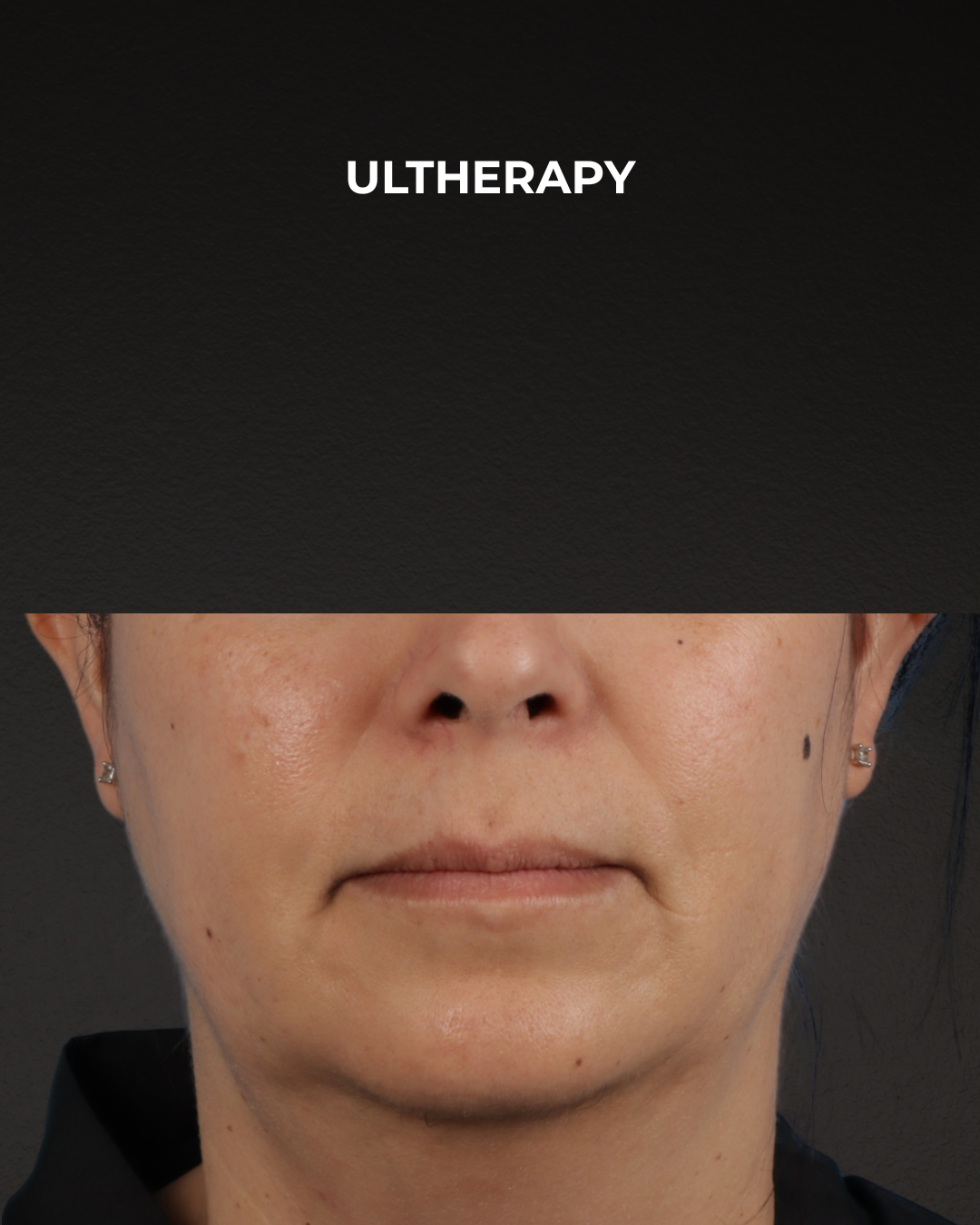 Ultherapy Before & After Gallery - Patient 385000 - Image 1