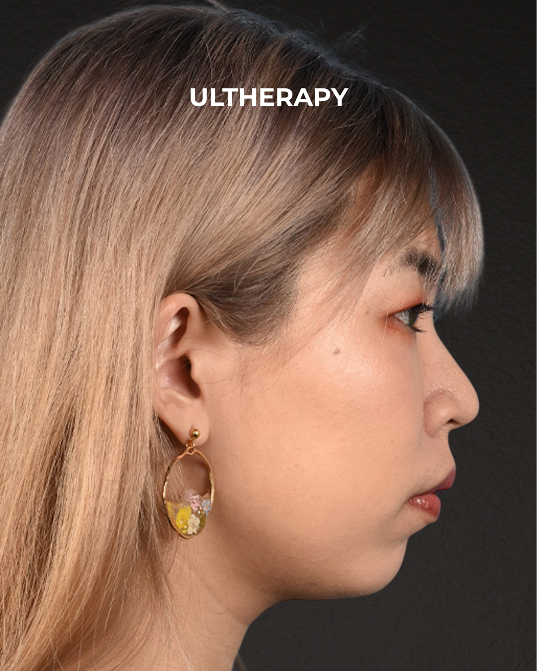 Ultherapy Before & After Gallery - Patient 103120 - Image 6