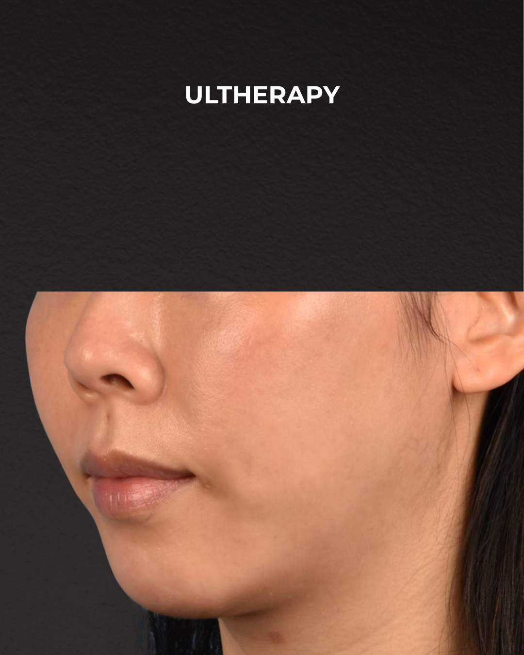 Ultherapy Before & After Gallery - Patient 134425 - Image 4