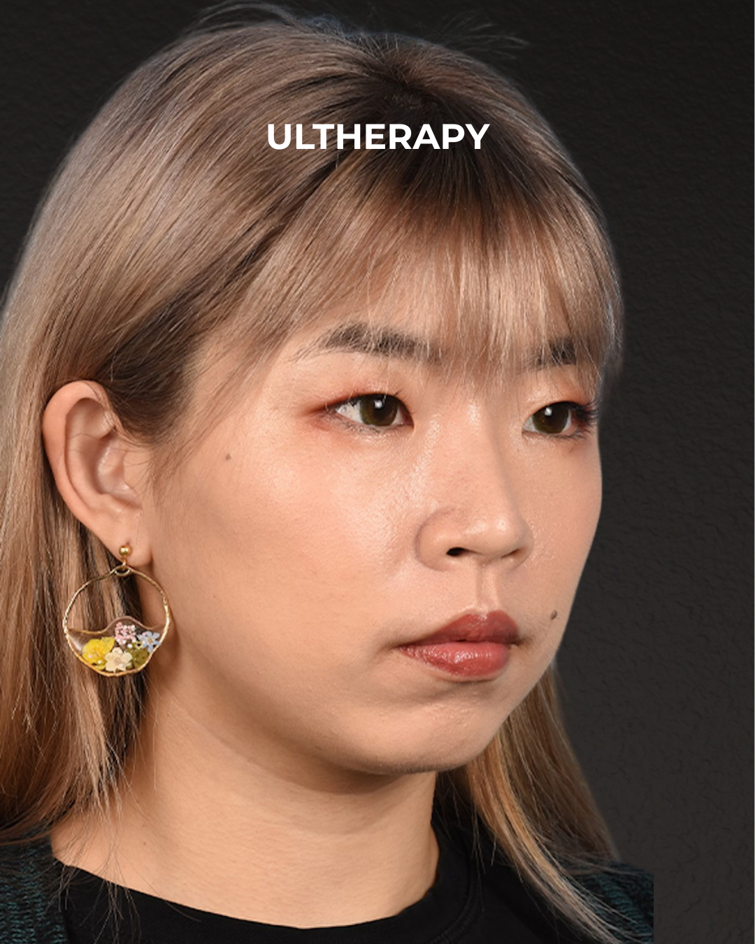 Ultherapy Before & After Gallery - Patient 103120 - Image 4