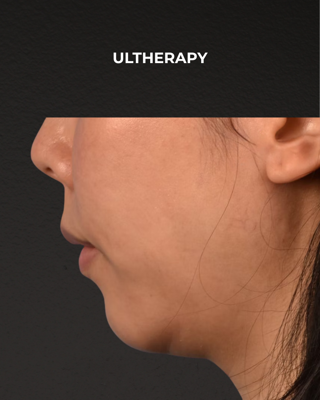 Ultherapy Before & After Gallery - Patient 134425 - Image 6