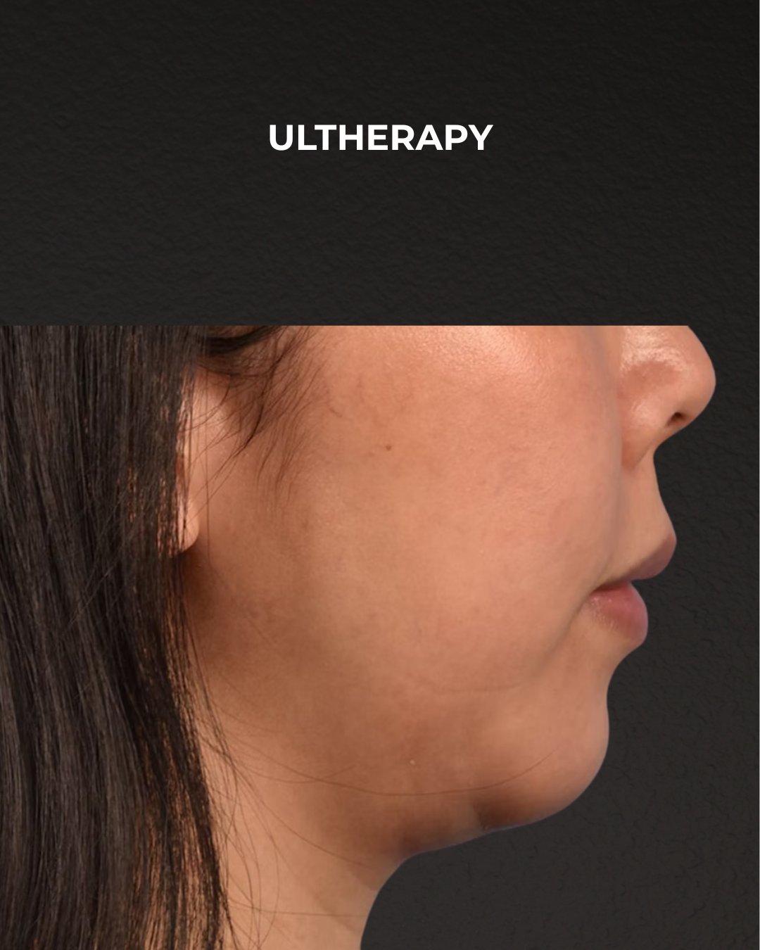Ultherapy Before & After Gallery - Patient 134425 - Image 8