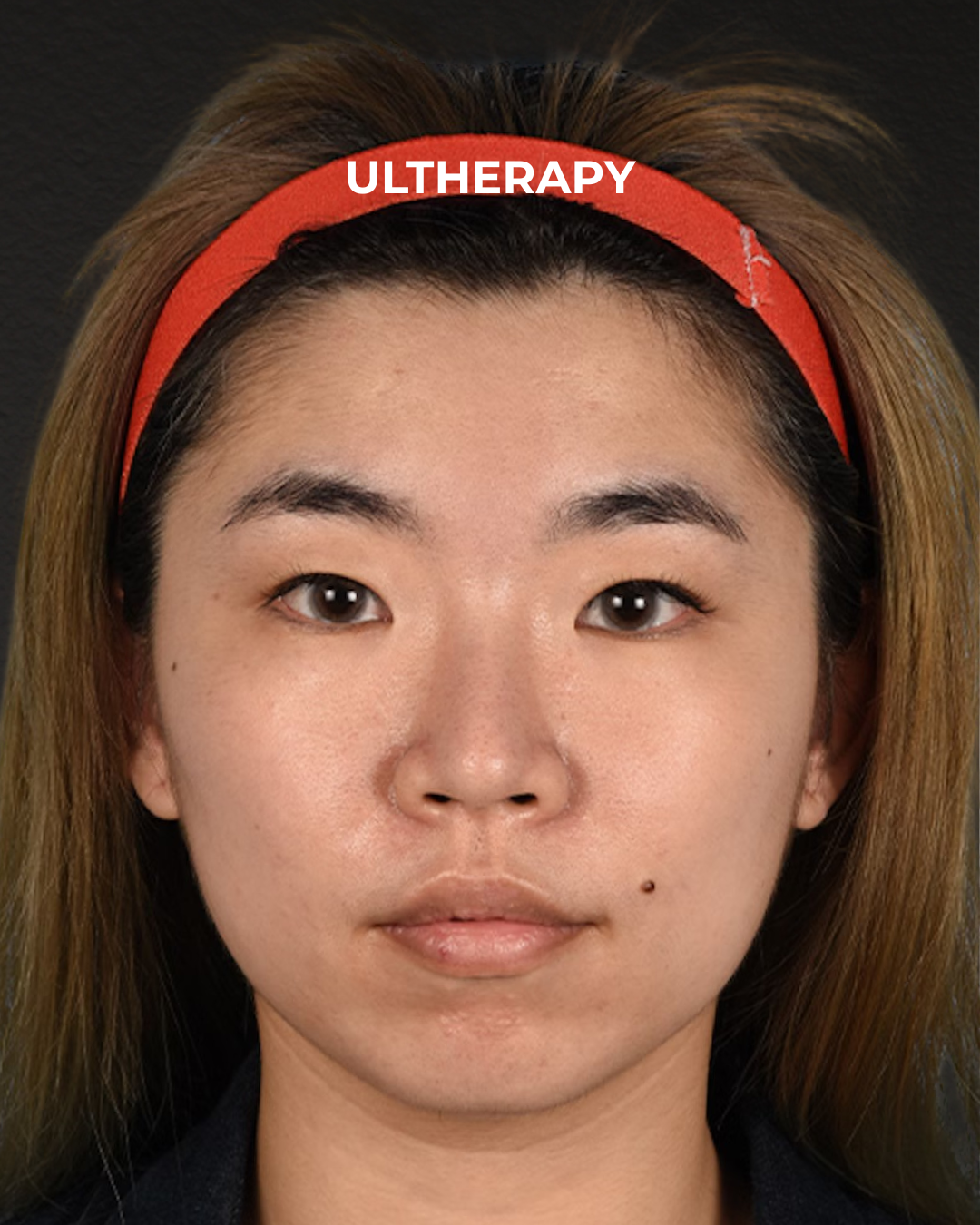 Ultherapy Before & After Gallery - Patient 103120 - Image 1