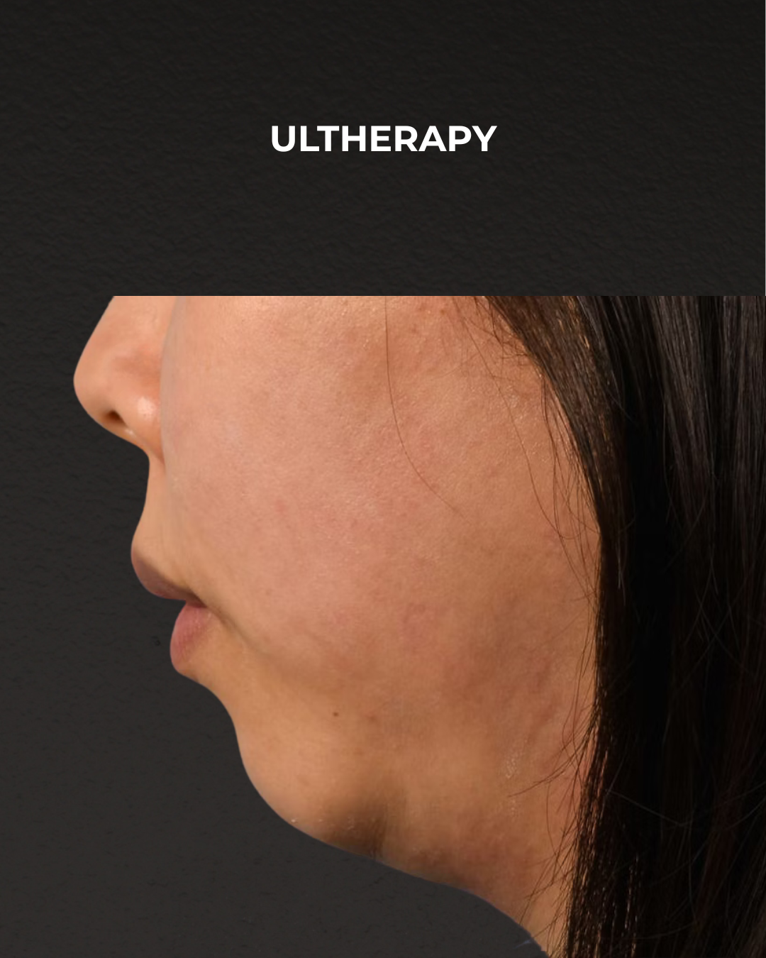 Ultherapy Before & After Gallery - Patient 134425 - Image 5