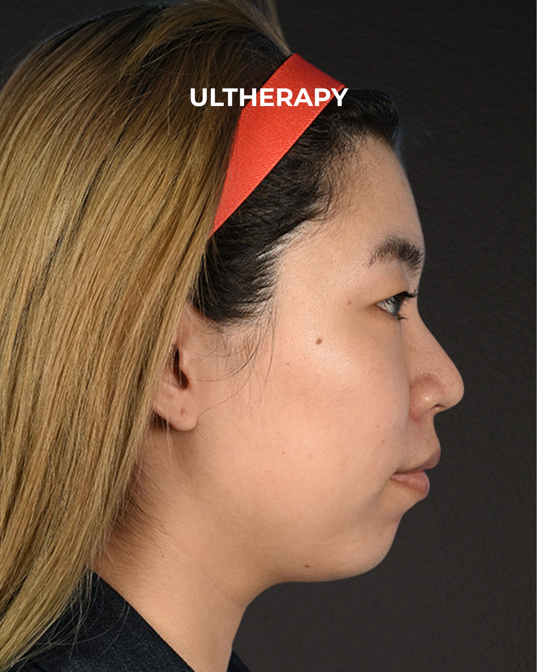 Ultherapy Before & After Gallery - Patient 103120 - Image 5