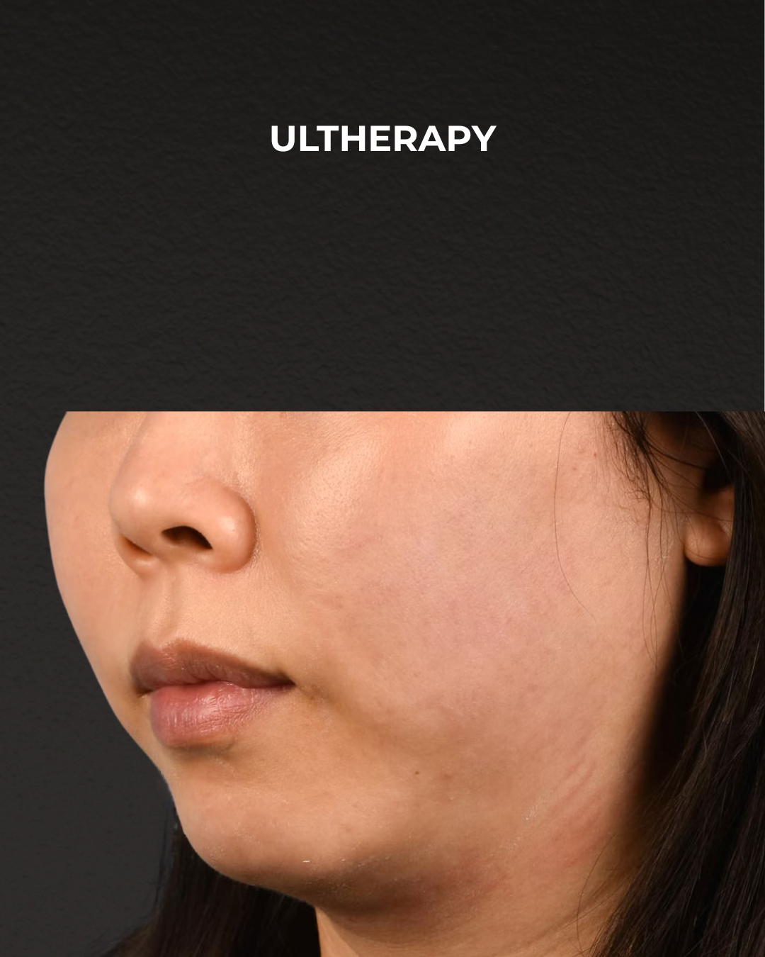 Ultherapy Before & After Gallery - Patient 134425 - Image 3