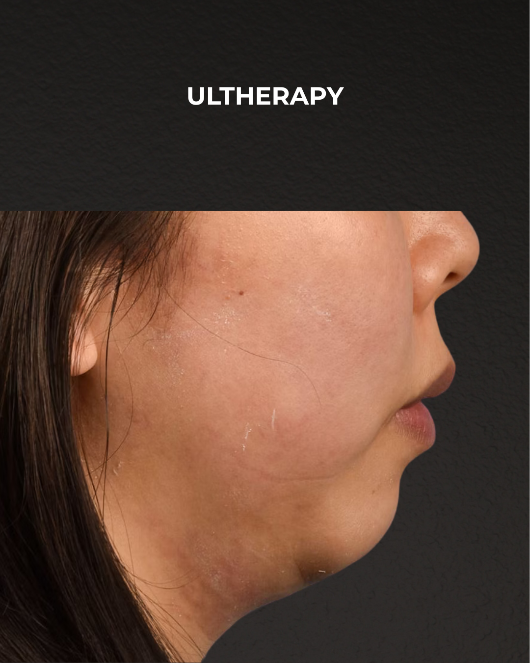 Ultherapy Before & After Gallery - Patient 134425 - Image 7