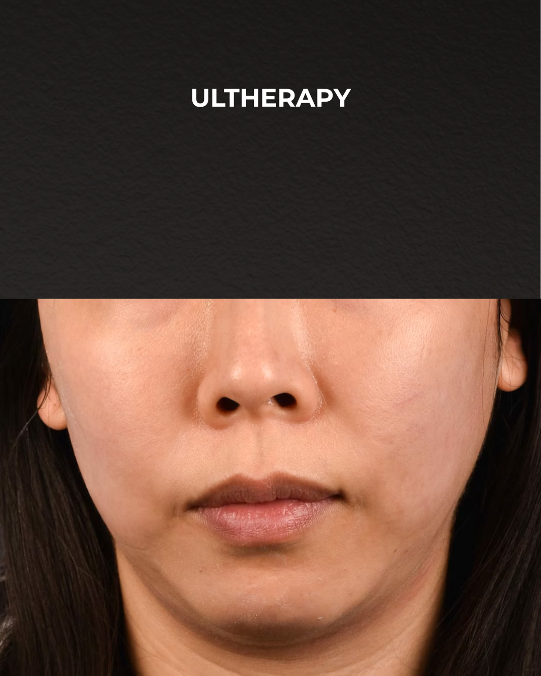 Ultherapy Before & After Gallery - Patient 134425 - Image 1