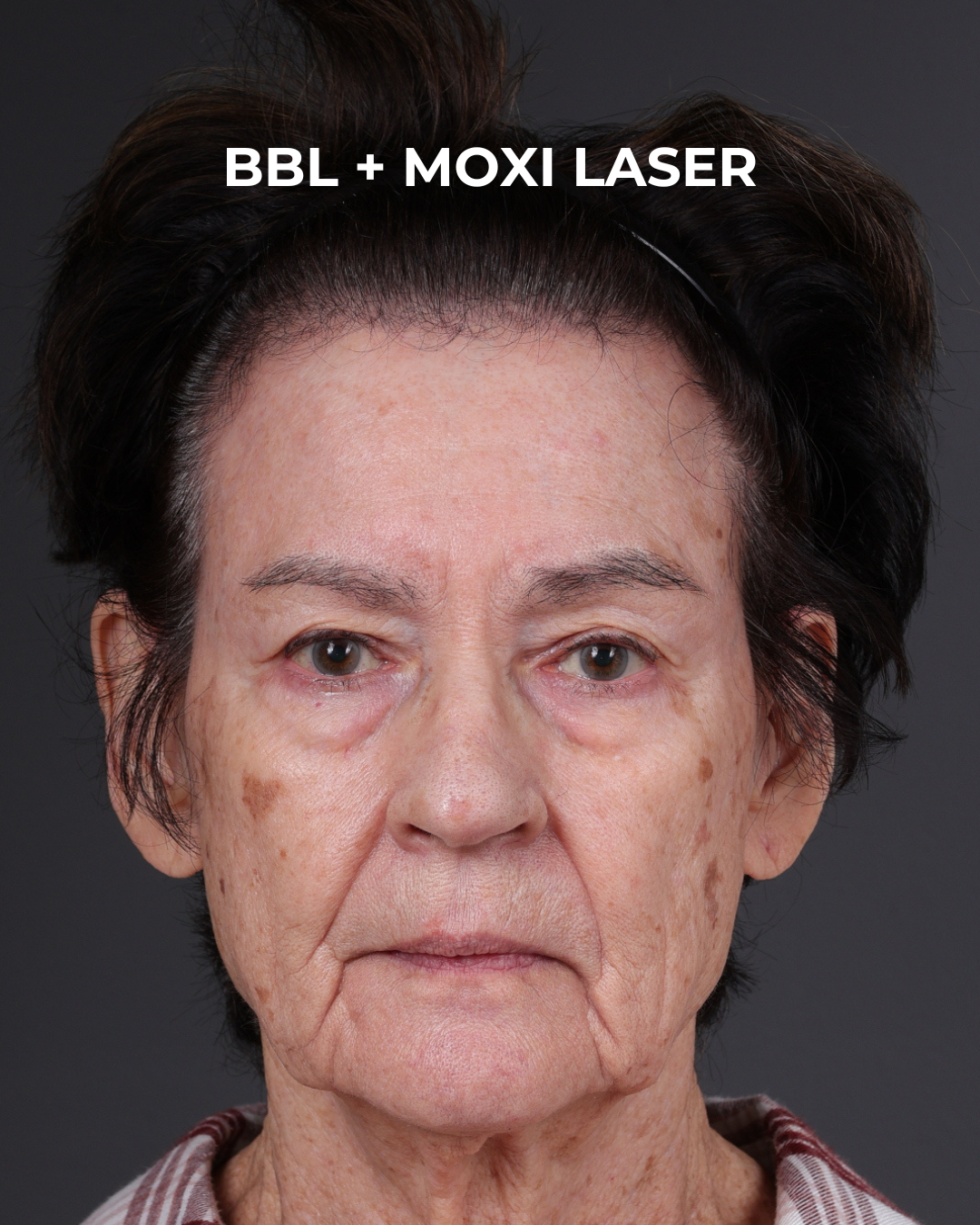Pigment Laser Before & After Gallery - Patient 182306 - Image 1