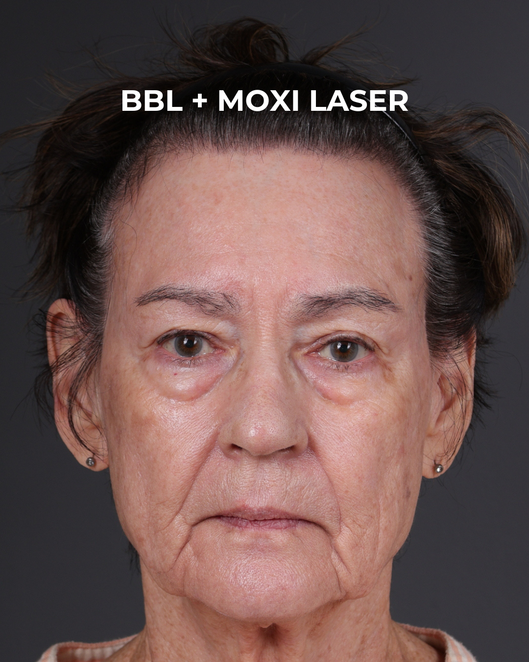 Pigment Laser Before & After Gallery - Patient 182306 - Image 2