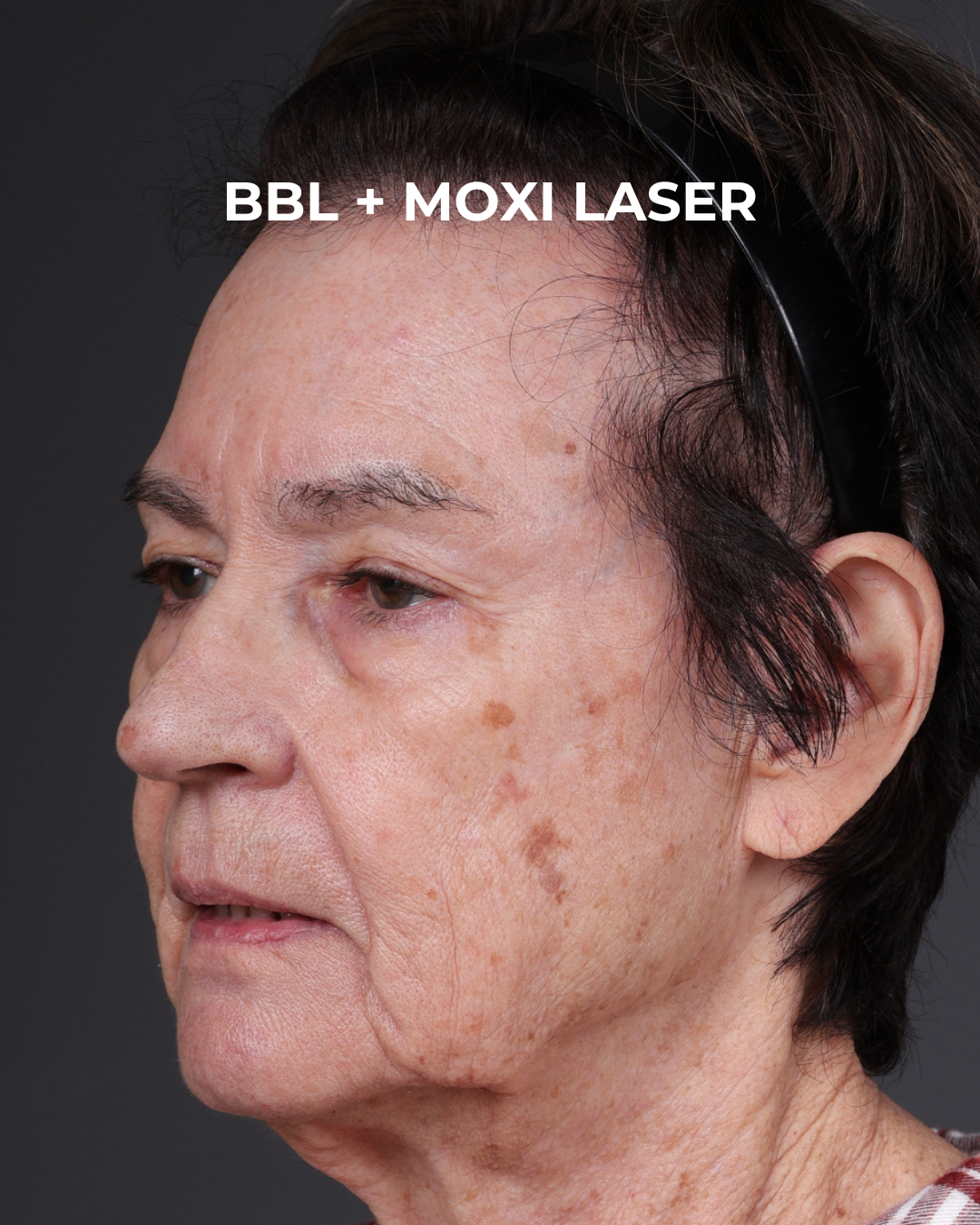 Pigment Laser Before & After Gallery - Patient 182306 - Image 3