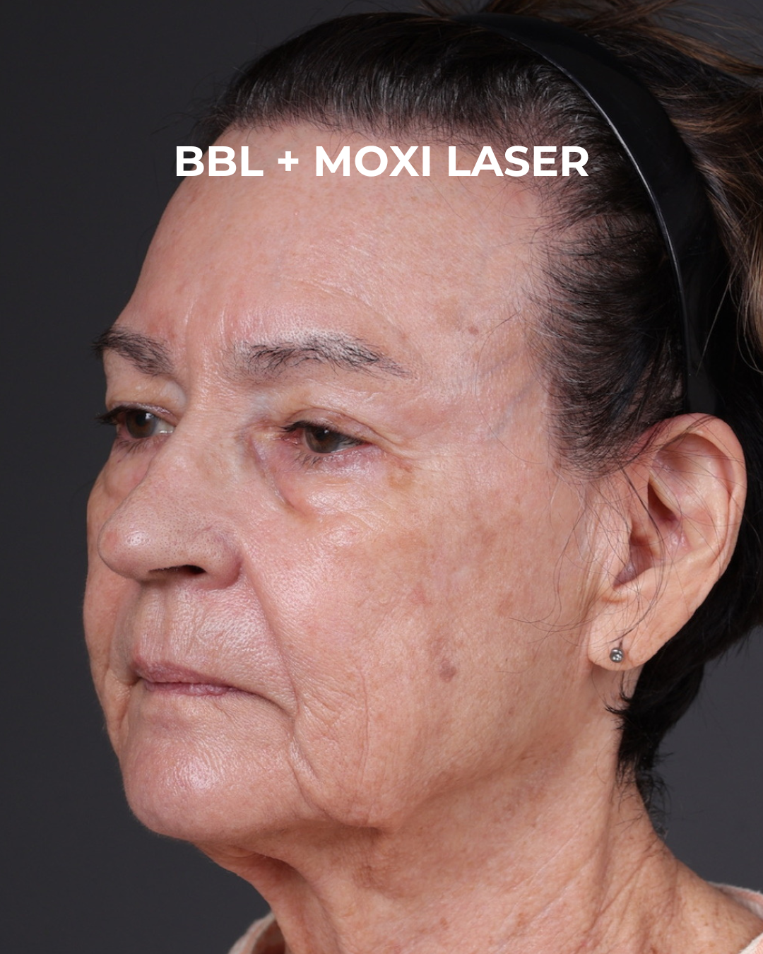 Pigment Laser Before & After Gallery - Patient 182306 - Image 4