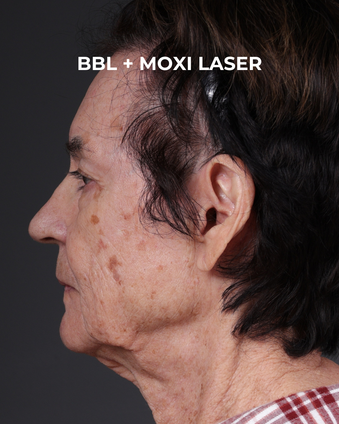 Pigment Laser Before & After Gallery - Patient 182306 - Image 5
