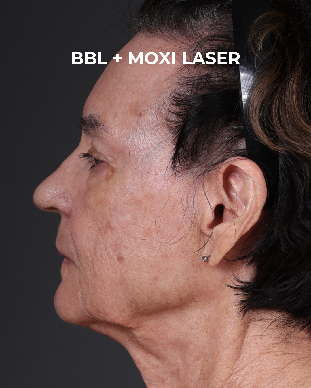 Pigment Laser Before & After Gallery - Patient 182306 - Image 6