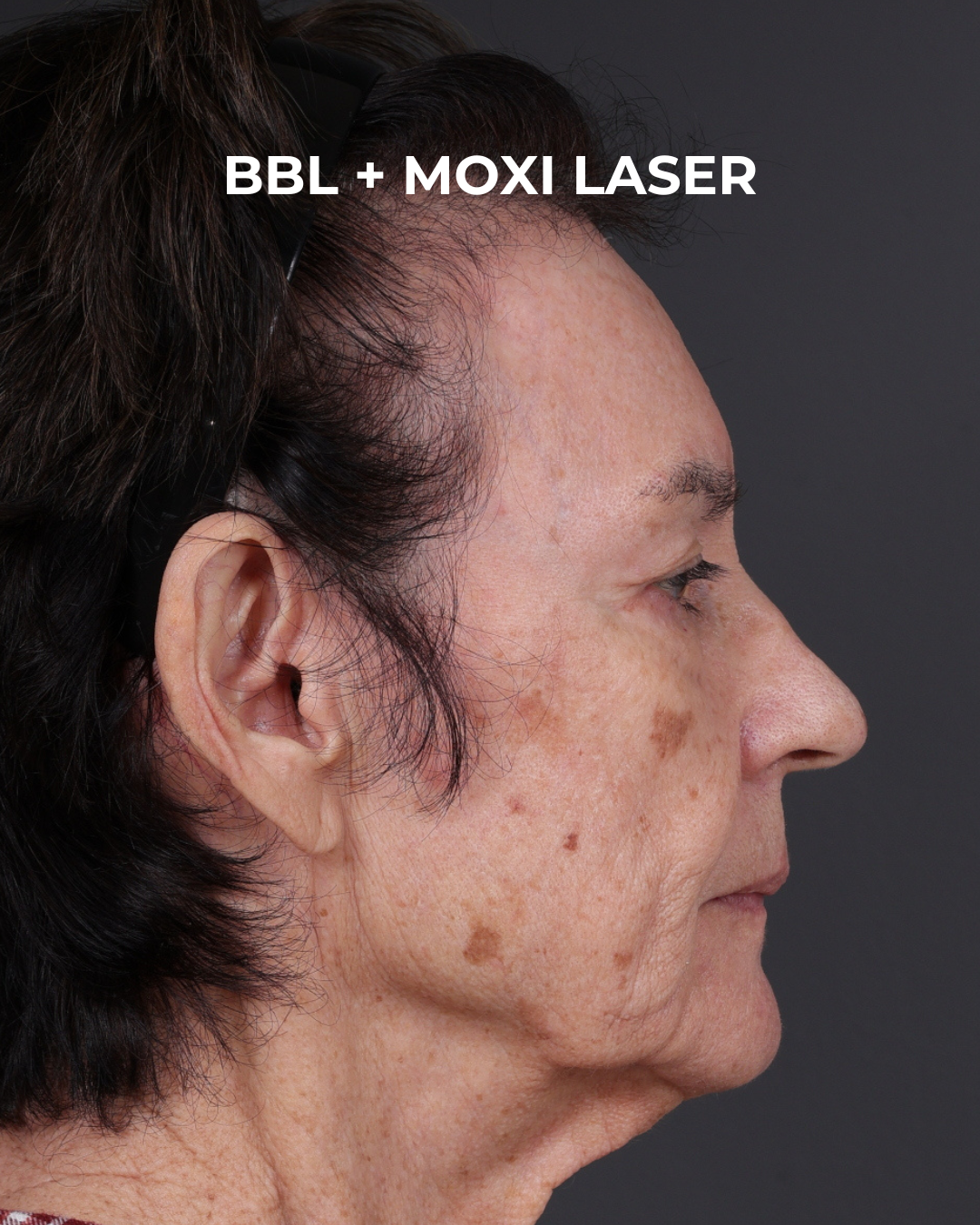 Pigment Laser Before & After Gallery - Patient 182306 - Image 7