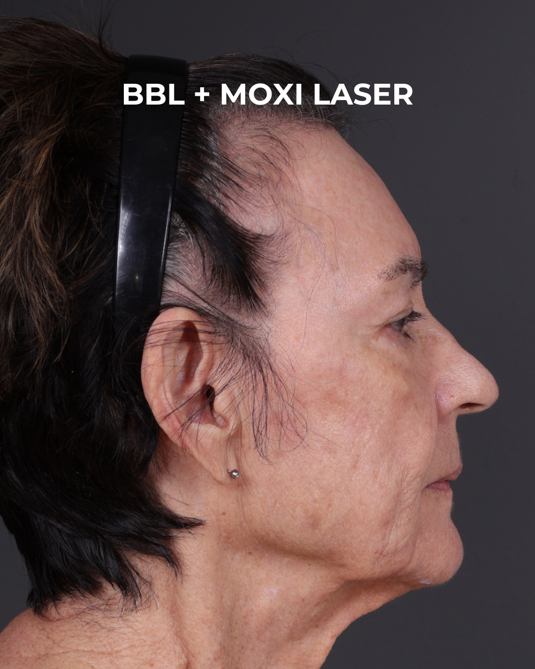 Pigment Laser Before & After Gallery - Patient 182306 - Image 8
