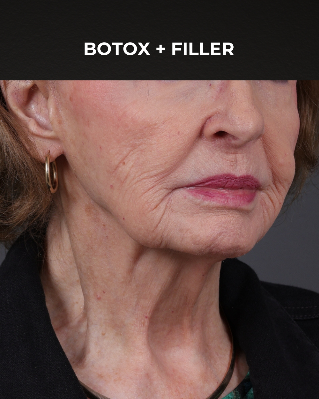 Dermal Fillers Before & After Gallery - Patient 742636 - Image 3