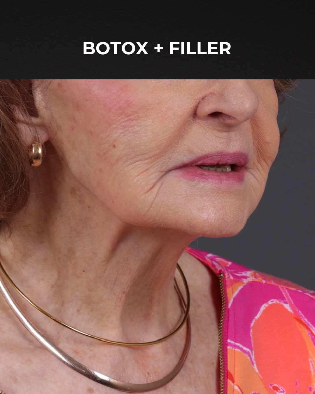 Dermal Fillers Before & After Gallery - Patient 742636 - Image 4