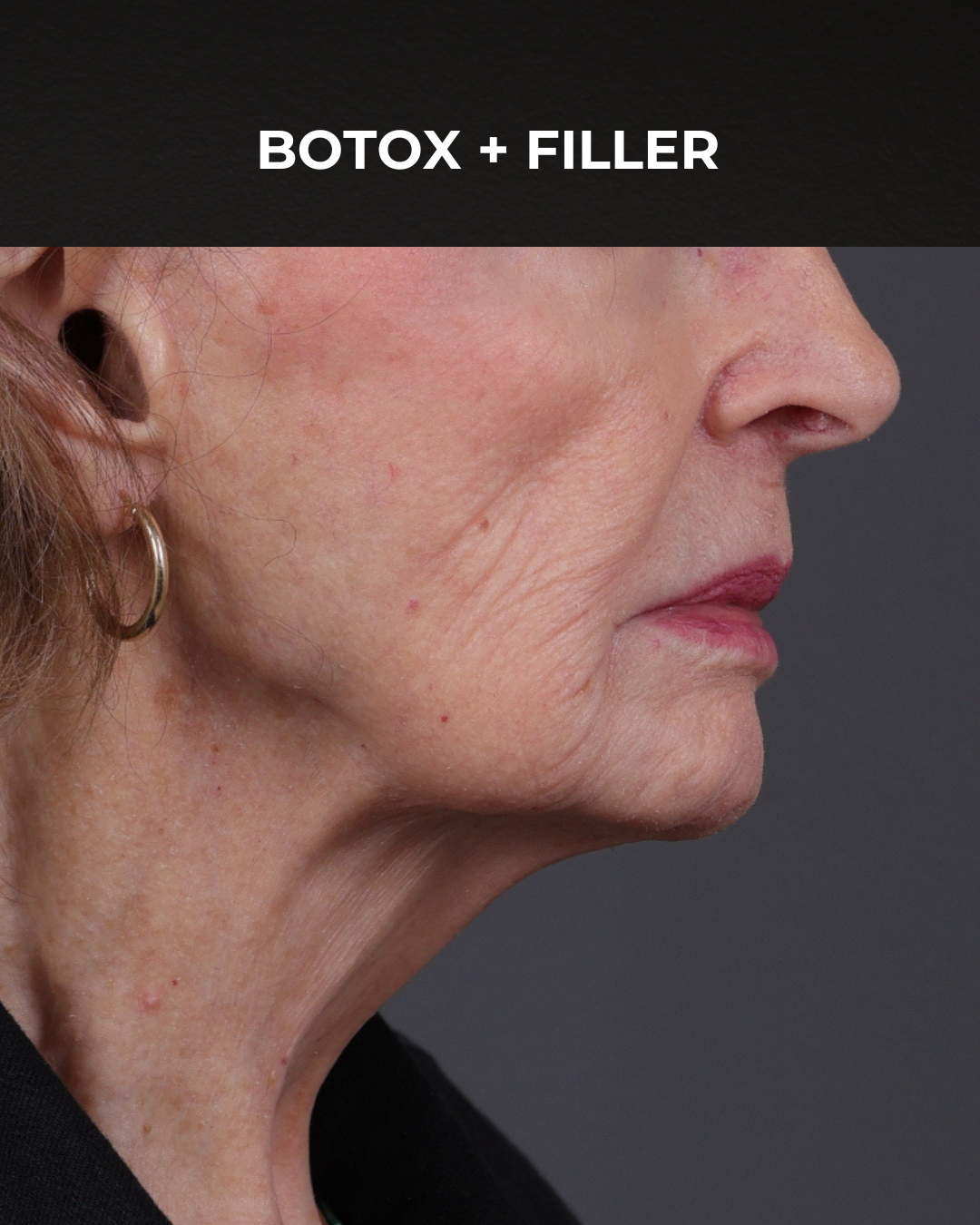 Dermal Fillers Before & After Gallery - Patient 742636 - Image 5