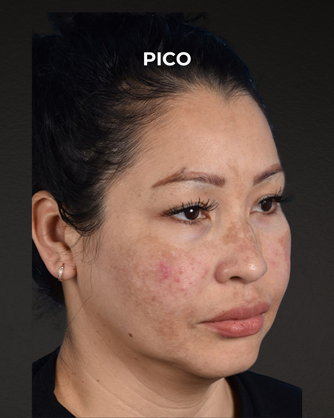Pigment Laser Before & After Gallery - Patient 555927 - Image 3