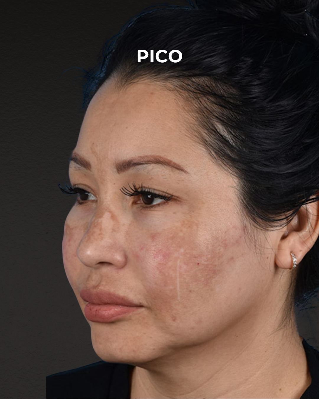 Pigment Laser Before & After Gallery - Patient 555927 - Image 5