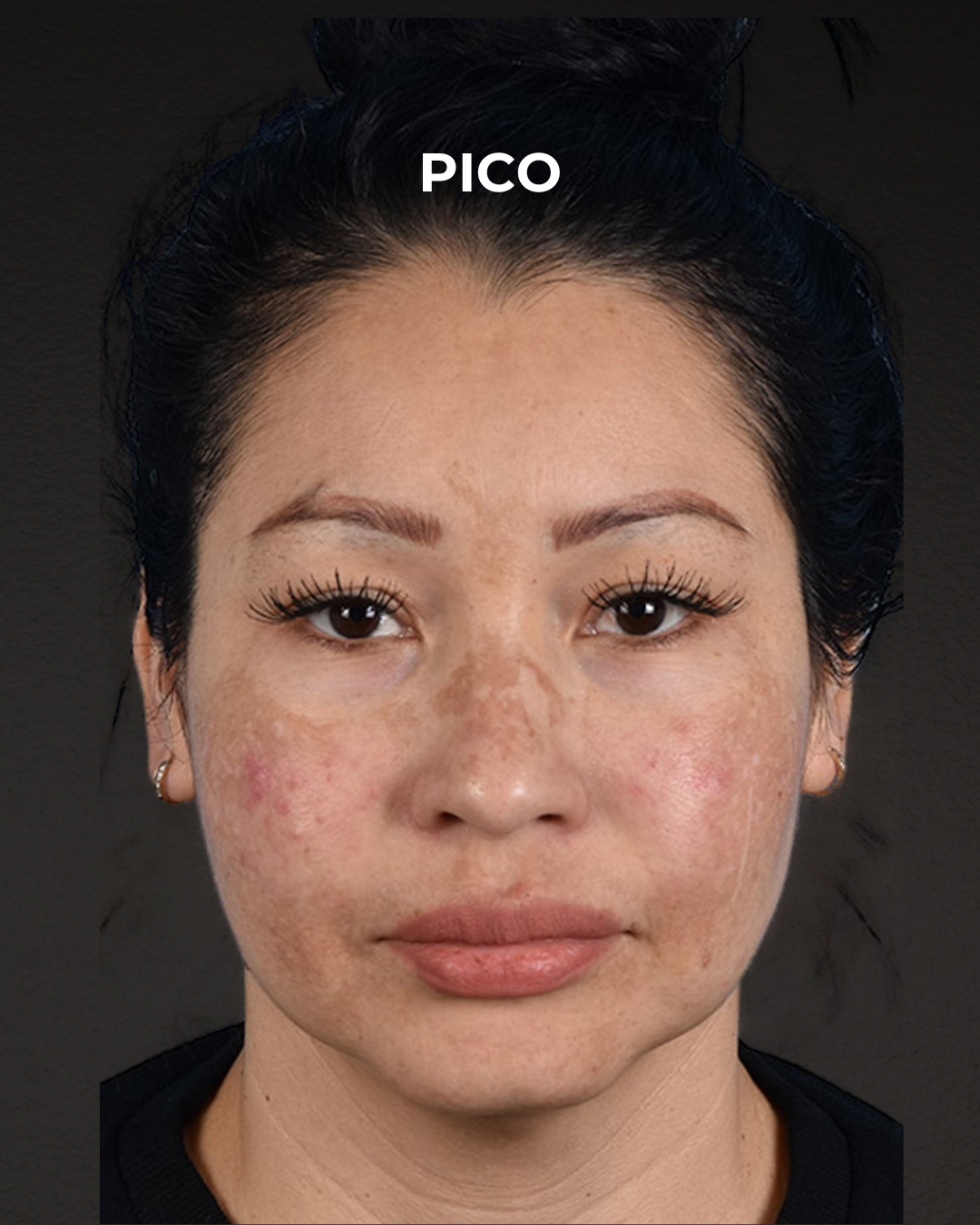 Pigment Laser Before & After Gallery - Patient 555927 - Image 1