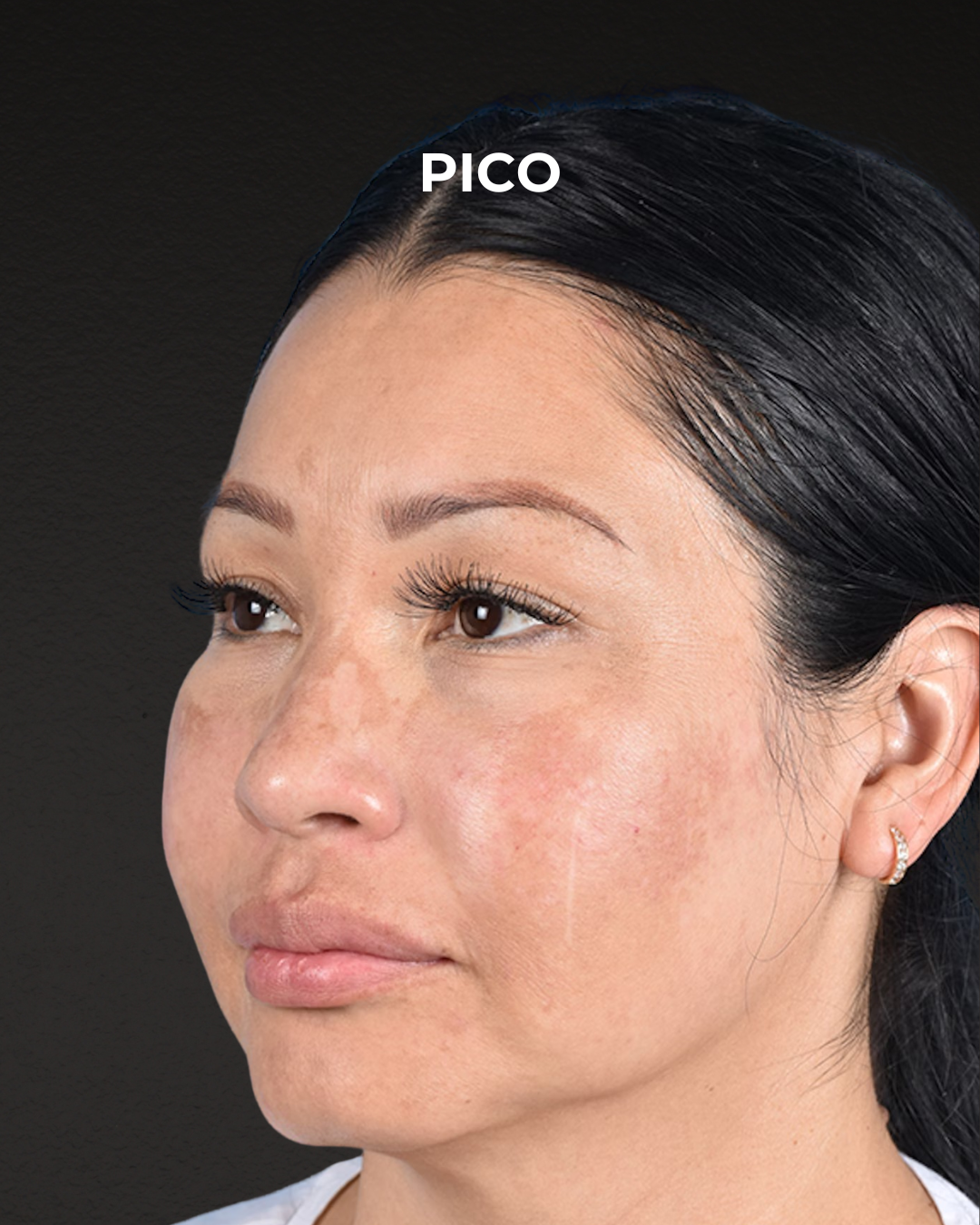 Pigment Laser Before & After Gallery - Patient 555927 - Image 6
