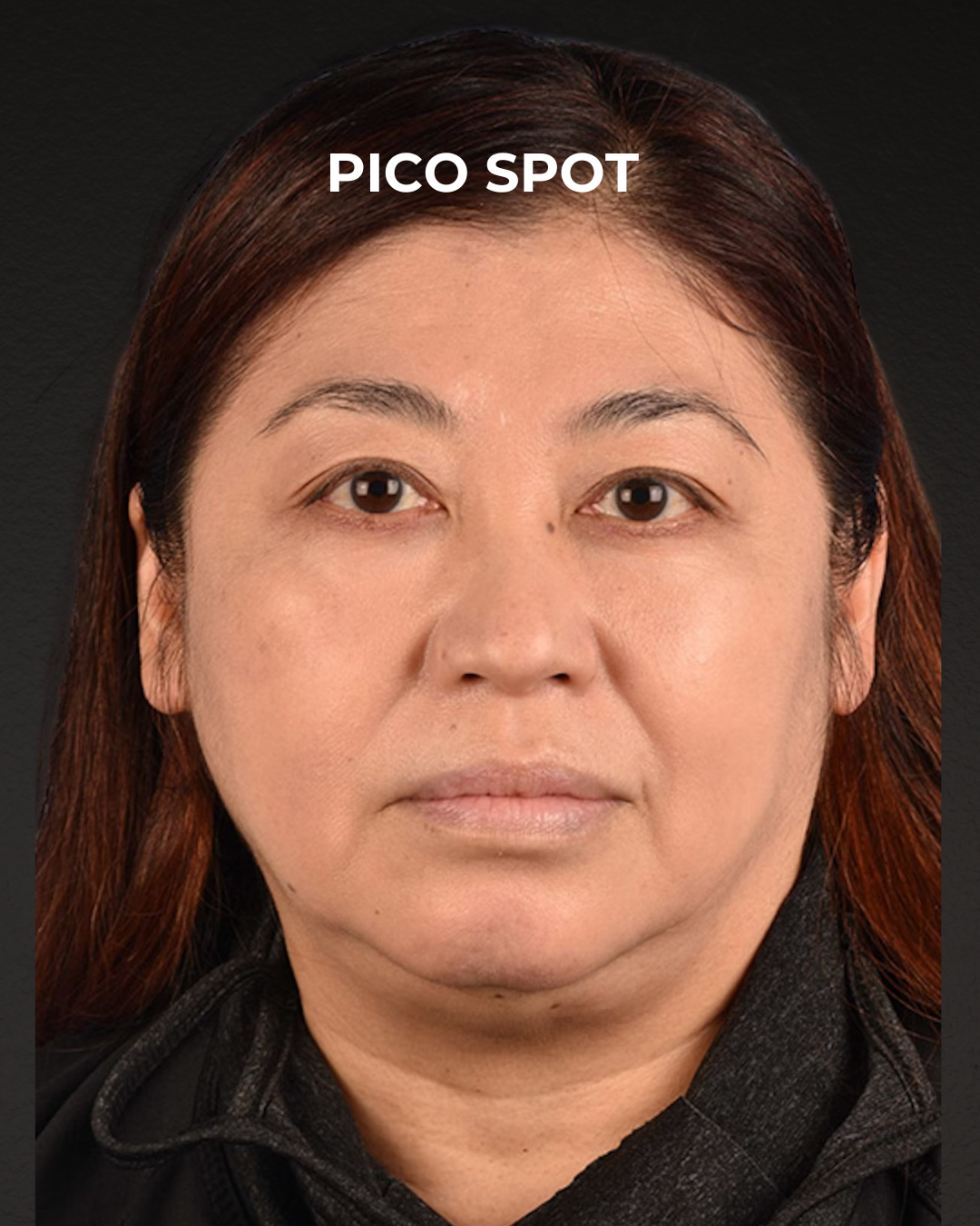 Pigment Laser Before & After Gallery - Patient 332305 - Image 2