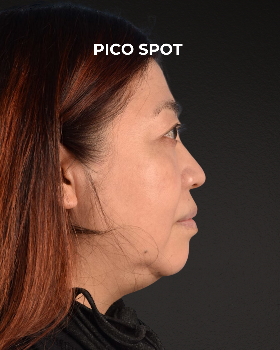 Pigment Laser Before & After Gallery - Patient 332305 - Image 4