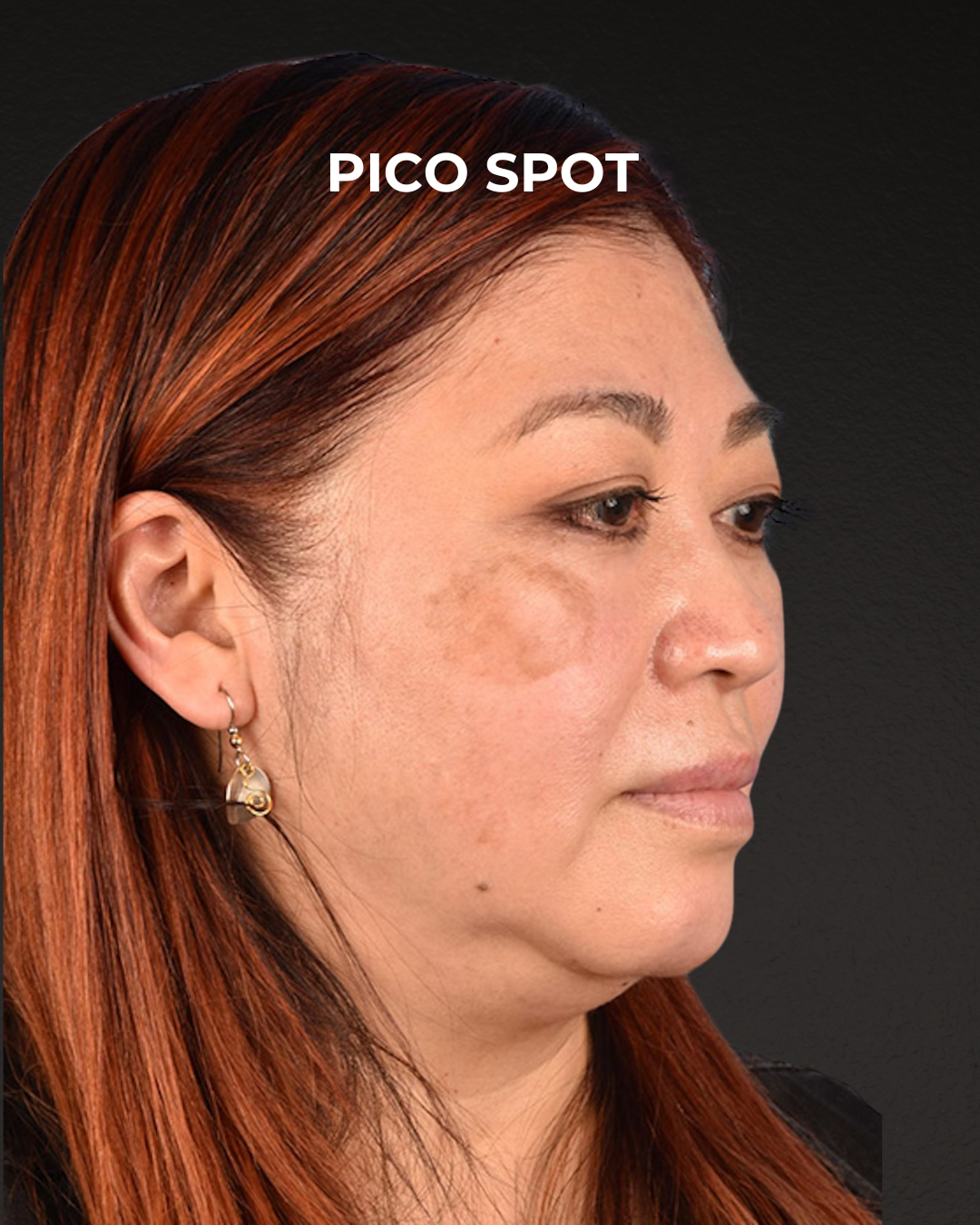 Pigment Laser Before & After Gallery - Patient 332305 - Image 5