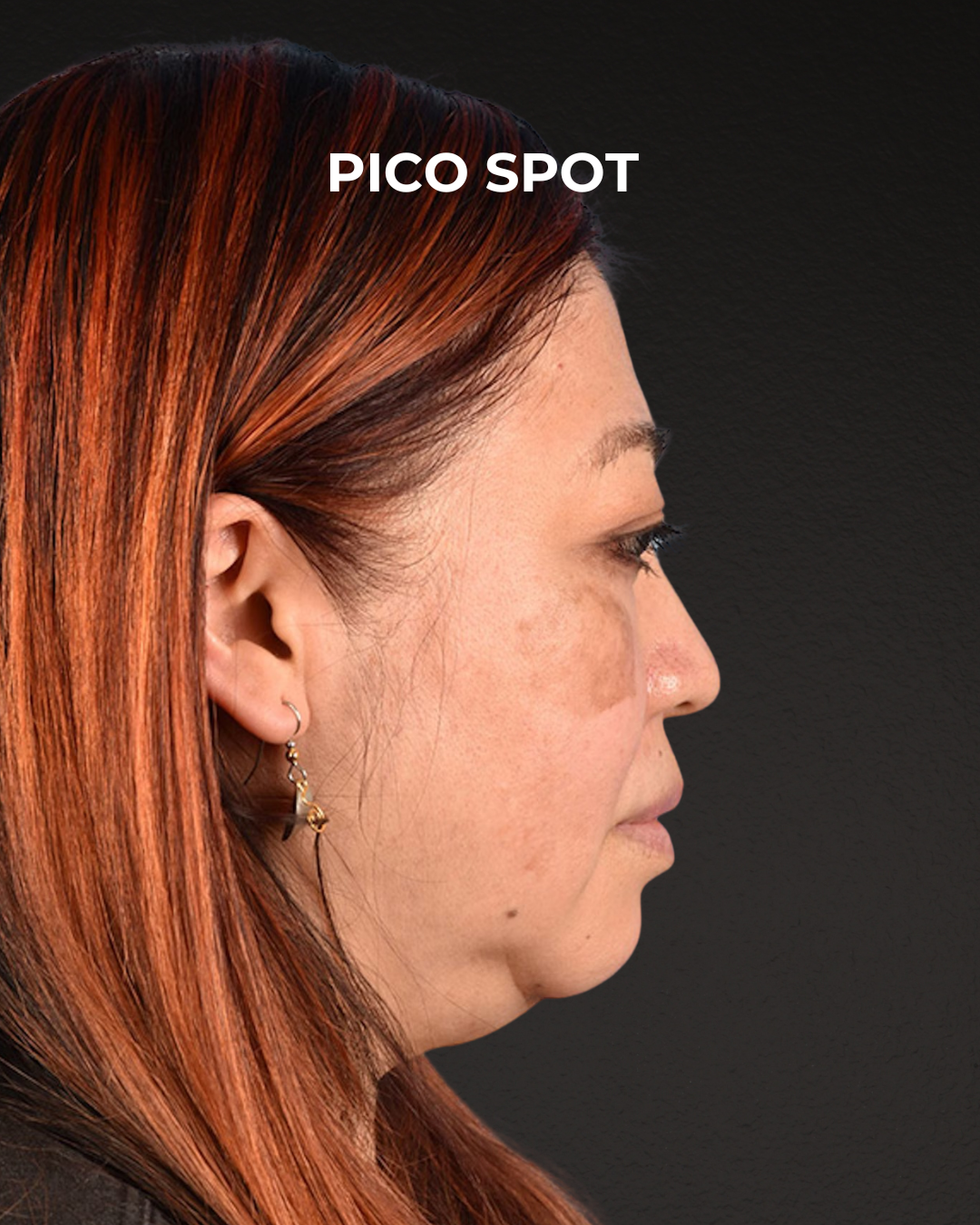 Pigment Laser Before & After Gallery - Patient 332305 - Image 3