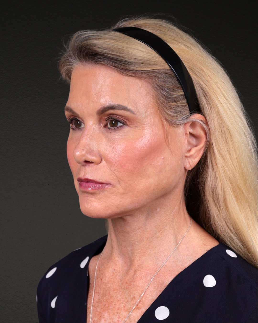 Facelift Before & After Gallery - Patient 105916 - Image 8