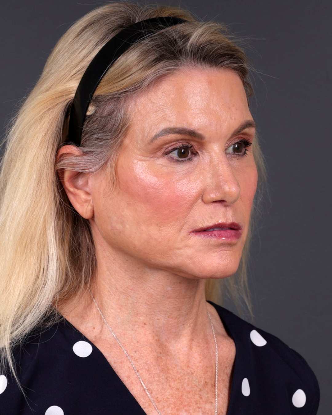 Facelift Before & After Gallery - Patient 105916 - Image 4