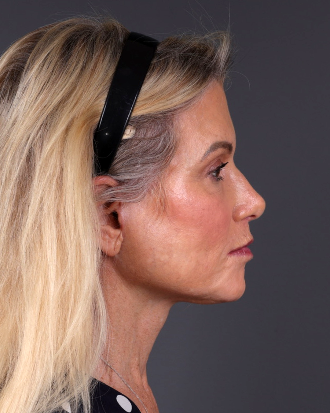 Facelift Before & After Gallery - Patient 105916 - Image 6