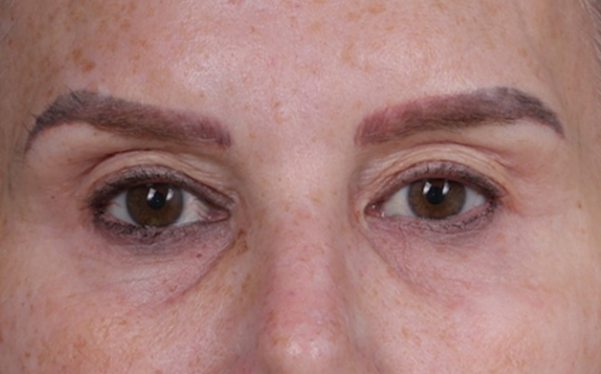 Brow Lift Before & After Gallery - Patient 320616 - Image 1