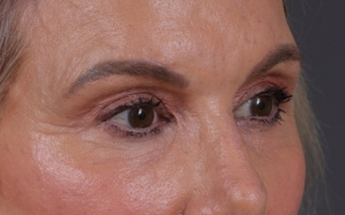 Brow Lift Before & After Gallery - Patient 320616 - Image 4