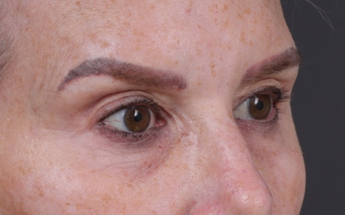 Brow Lift Before & After Gallery - Patient 320616 - Image 3
