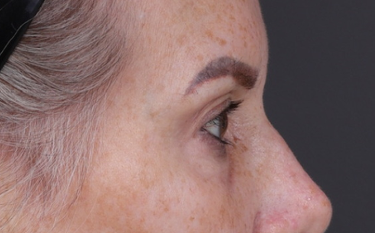 Brow Lift Before & After Gallery - Patient 320616 - Image 5