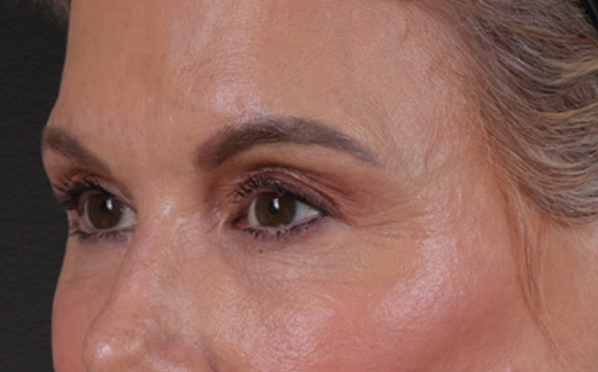 Brow Lift Before & After Gallery - Patient 320616 - Image 8