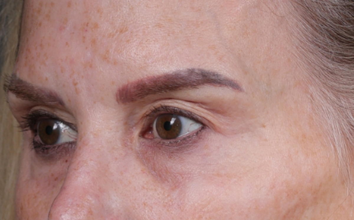 Brow Lift Before & After Gallery - Patient 320616 - Image 7
