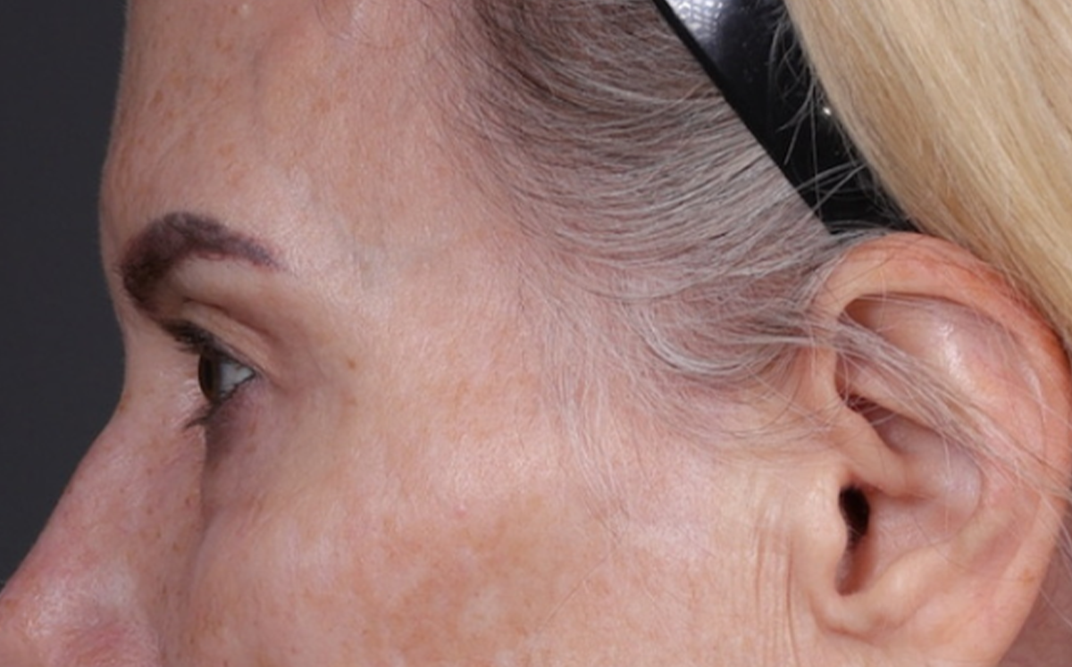 Brow Lift Before & After Gallery - Patient 320616 - Image 9