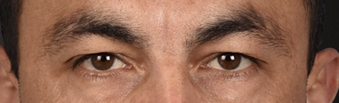 Blepharoplasty Before & After Gallery - Patient 167971 - Image 1