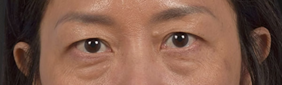 Blepharoplasty Before & After Gallery - Patient 284163 - Image 1