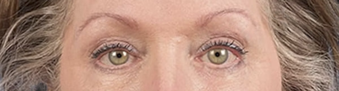 Blepharoplasty Before & After Gallery - Patient 362822 - Image 2