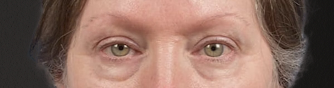Blepharoplasty Before & After Gallery - Patient 362822 - Image 1